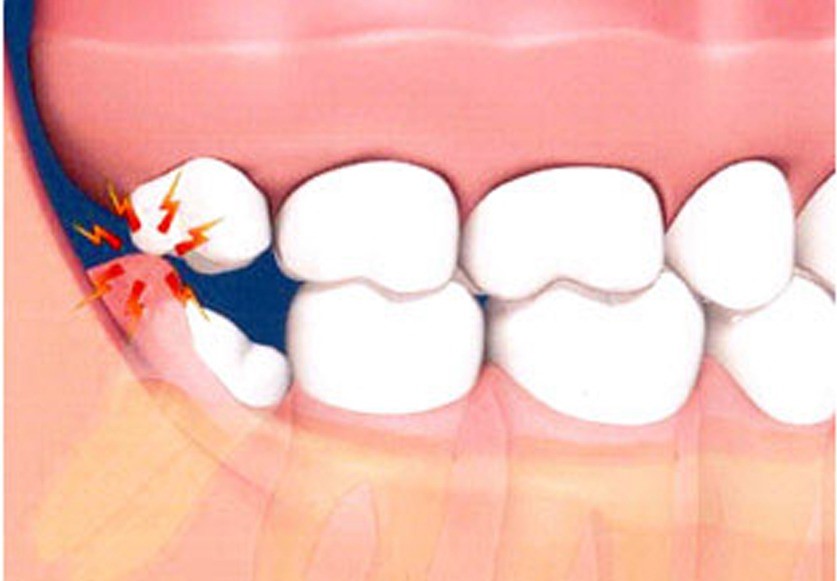 نشانه‌های درآمدن دندان عقل