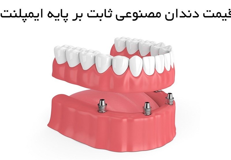 دندان مصنوعی بر پایه ایمپلنت