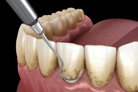 برای اولین وعده بعد از جرم‌گیری دندان چی انتخاب کنیم؟