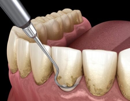 برای اولین وعده بعد از جرم‌گیری دندان چی انتخاب کنیم؟